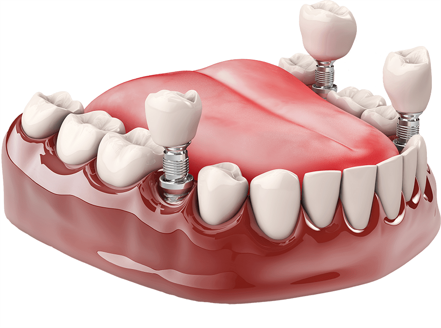 dental implants model Chicago IL