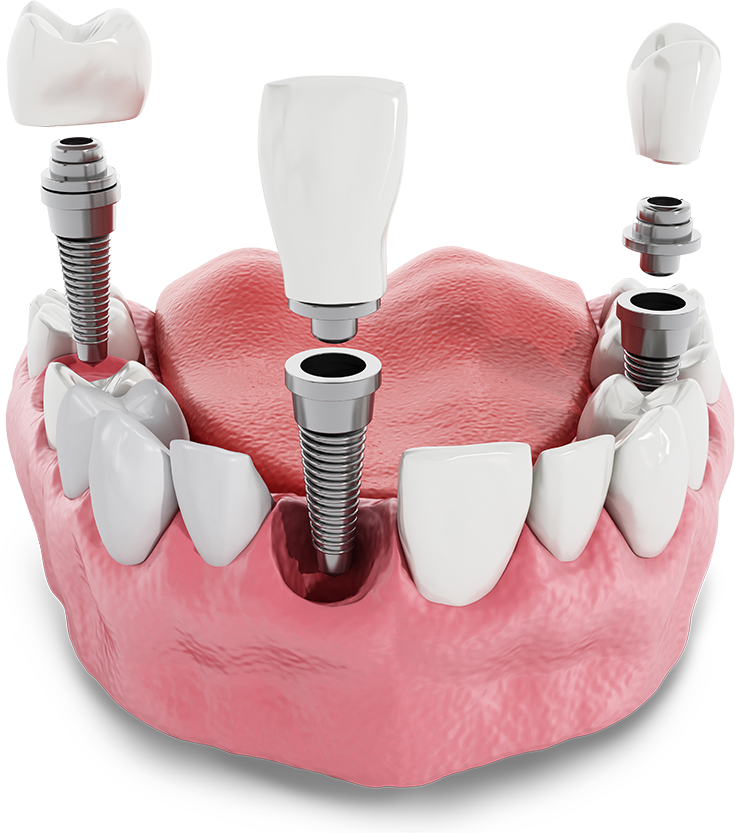 dental implants model Chicago IL