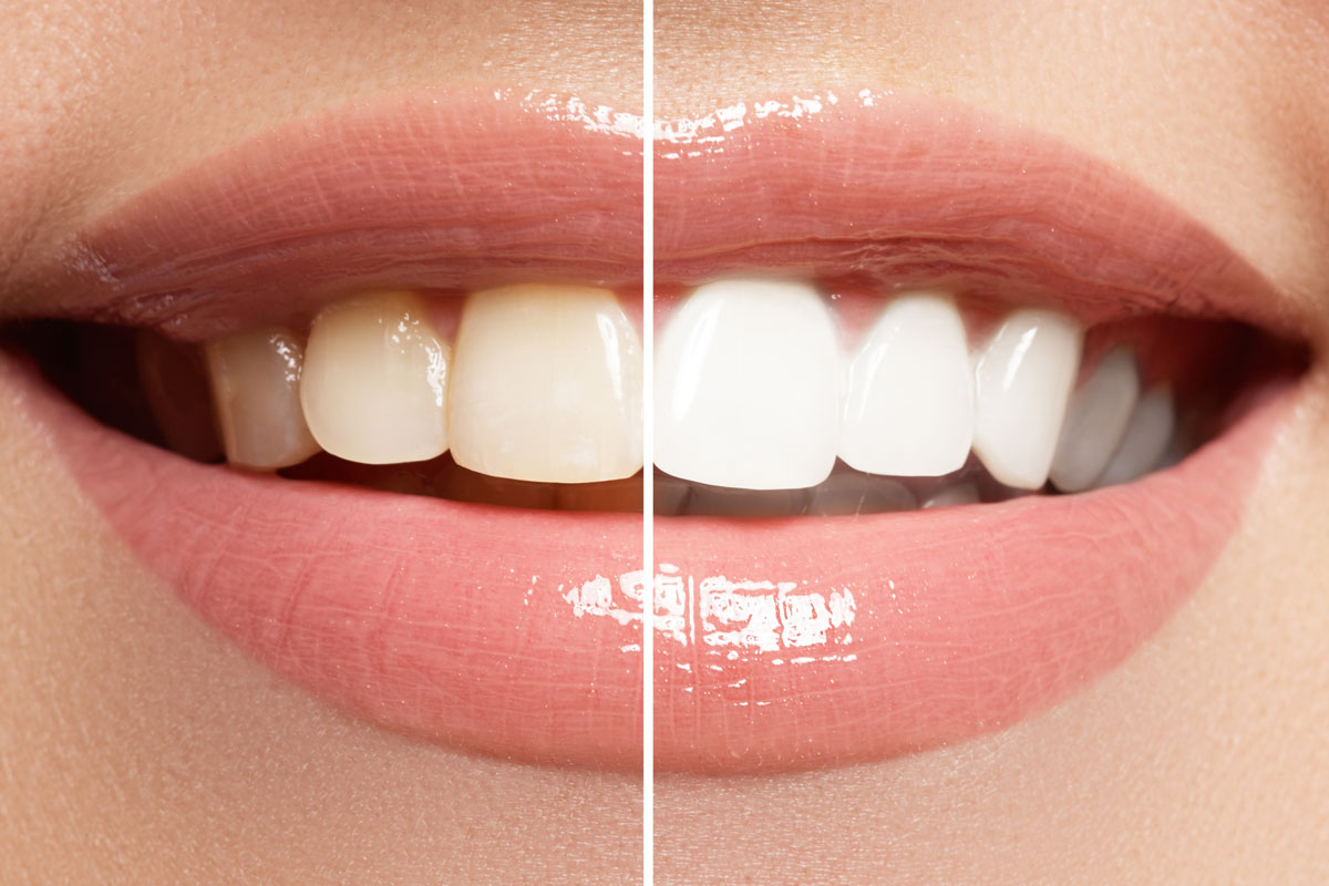 teeth whitening before and after Chicago IL